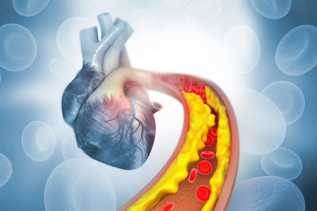 Chelation Therapy