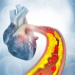 Chelation Therapy