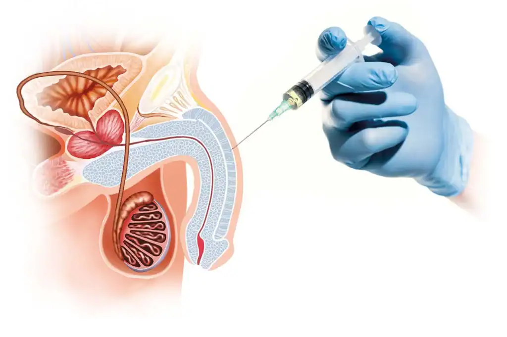 The P-Shot medical procedure used for male sexual wellness treatment