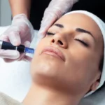 Vampire Facelift (Platelet Rich Plasma (PRP) Aesthetics
