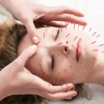Acupuncture