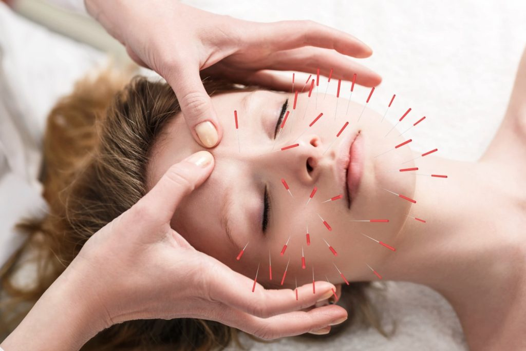 Acupuncture